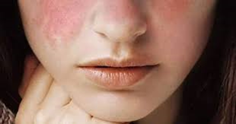 Lúpus Eritematoso Sistêmico (LES)