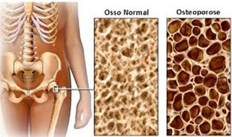 Osteoporose